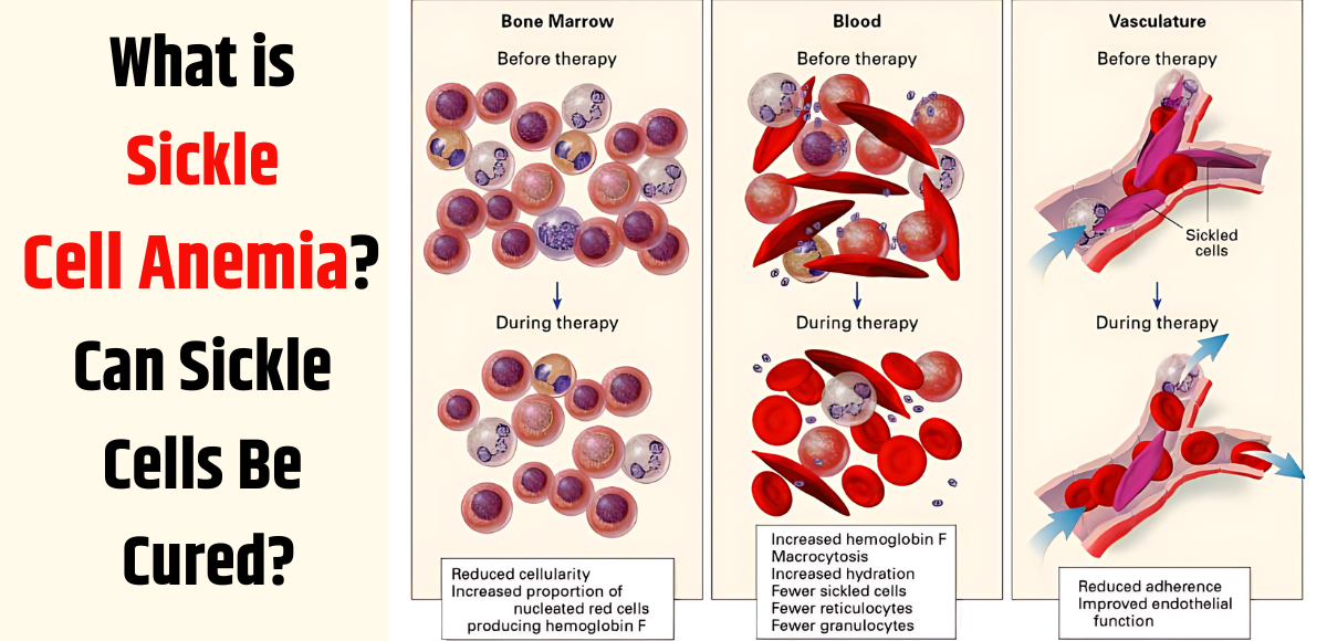 What is sickle cell anemia? Can sickle cells be cured?