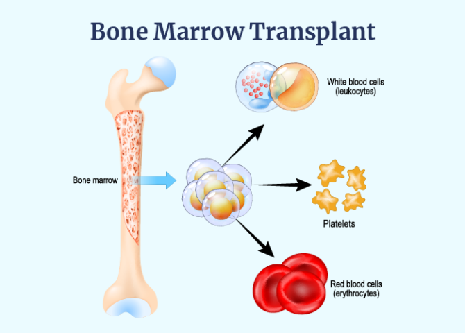 How to Find a Bone Marrow Donor Match: Resources and Tips