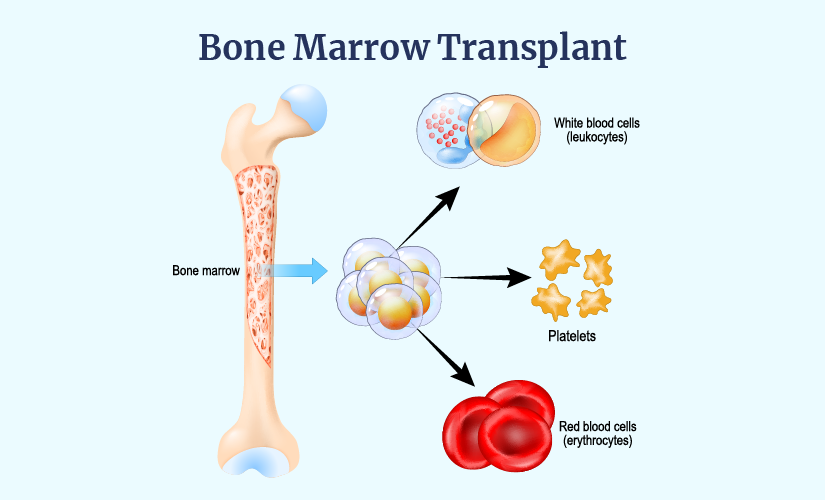 How to Find a Bone Marrow Donor Match: Resources and Tips